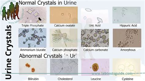 Urine Crystals: Causes, Symptoms, and Treatment - A Comprehensive Guide