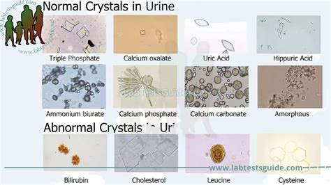 Crystals in Urine: Causes, Symptoms, and Treatment - A Comprehensive Guide