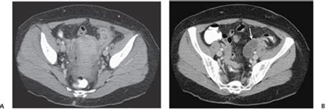 132 Pelvic Inflammatory Disease with Tubo-ovarian Abscess | Radiology Key