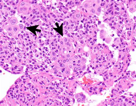 Mesothelioma Histology Psammoma