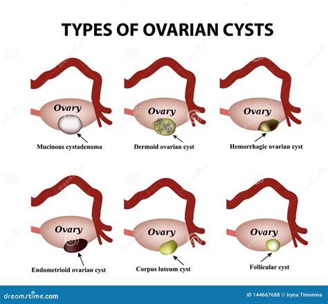 Types of Ovarian Cysts. Set. Infographics Stock Vector - Illustration ...