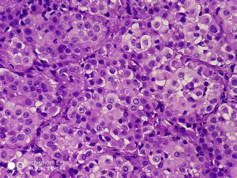 EPITHELIAL MALIGNANT MESOTHELIOMA – Histopathology.guru