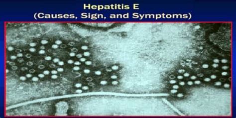 Hepatitis E (Causes, Sign, and Symptoms) - Assignment Point