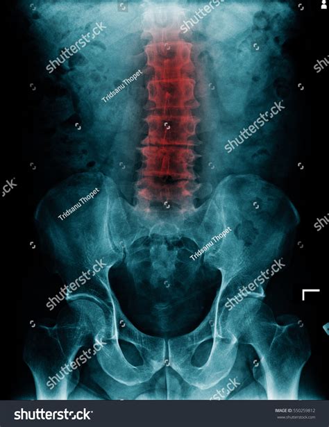 486 Degenerative Xray Images, Stock Photos & Vectors | Shutterstock