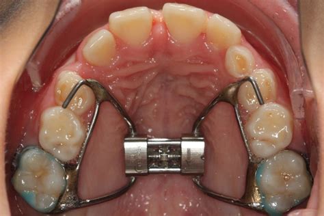 6 Things You Need To Know About The Rapid Palatal Expander