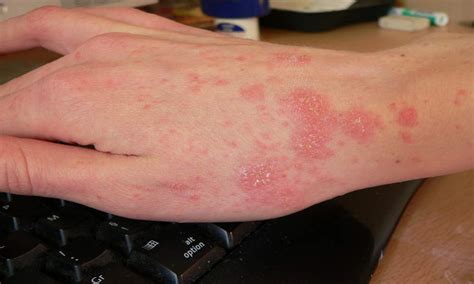 Scabies rash Look Like & Causes10