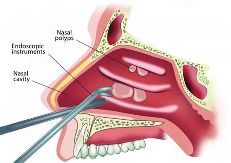 Nasal Polyps Removal: When Should You Remove Them?