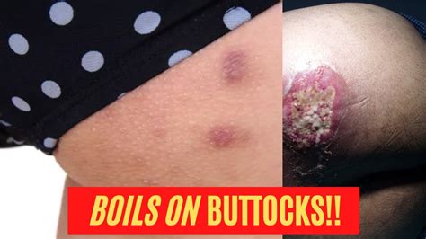 The 7 Most Effective Home REMEDIES for BOILS on BUTTOCKS | Boils ...