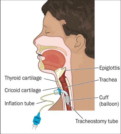 Tracheostomy Tube Insertion