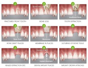 Bone Graft Mexico - Price List - All Types Of Dental Grafts - Dental ...