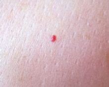 Blood Spots Removal – Abate MediSpa Sanctuary