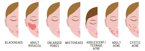 Acne Break-Outs: Causes, Symptoms, & Treatments [INFOGRAPHIC ...