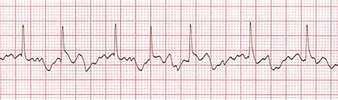 Atrial Fibrillation training - ACLS Cardiac Rhythms video | ProACLS