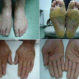 Case 1's hands and feet. | Download Scientific Diagram