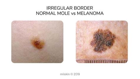 Melanoma Pictures Skin Melanomas Vs Non Cancerous Moles | Hot Sex Picture