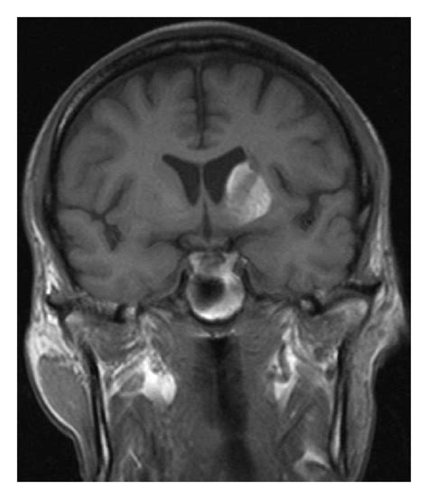 MRI changes in the left corpus striatum related to hemichorea ...