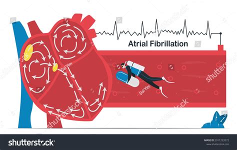 11 Atrial Fibrillation Fib Images, Stock Photos & Vectors | Shutterstock