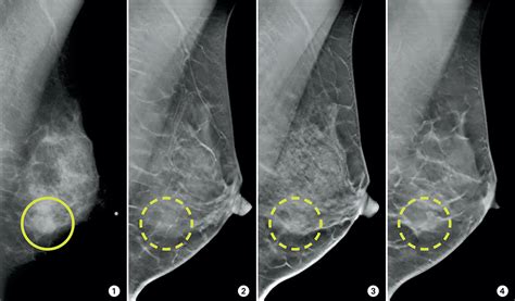 3-D mammograms may improve accuracy of breast cancer screening