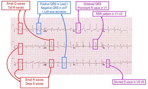 Bifascicular block causes, symptoms, diagnosis & treatment