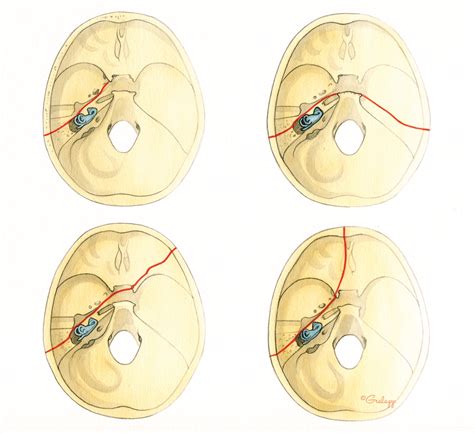 4 Wheeler Accident Temporal Bone Fracture Concept Map - Map