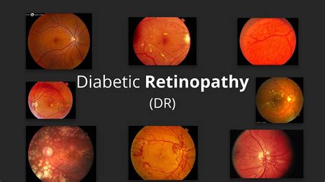 Diabetic Retinopathy (DR) - Pathophysiology, Stages, Screening ...