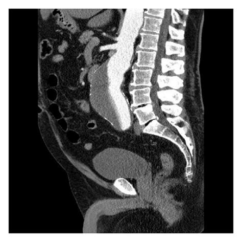 Juxtarenal abdominal aortic aneurysm 66 × 150 mm. | Download Scientific ...