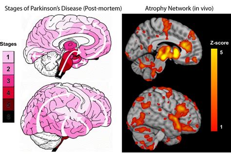 New study maps the progression of Parkinson’s disease within the brain ...