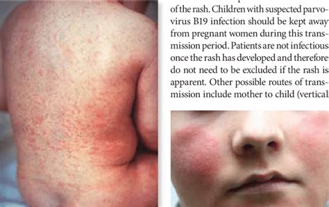 Rubella, or German measles. The maculopapular rash of rubella is ...