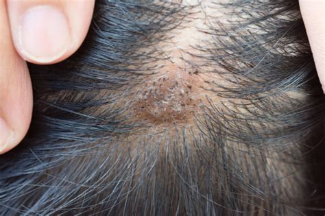 Scabs on Scalp: Causes, Signs, Symptoms, and How to Treat Them