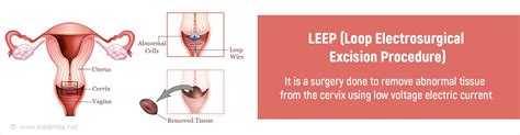 LEEP (Loop Electrosurgical Excision Procedure) - Indications ...