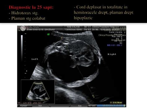 Hidrotorax fetal shunt pleuro amniotic