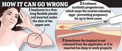 Arm Implant Birth Control Side Effects