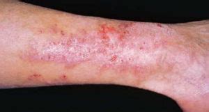 HealthoolRash in Celiac disease Rash Pictures Atlas of Rashes ...