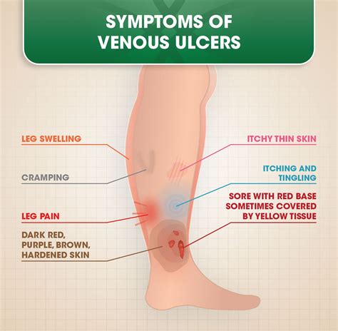 Venous Ulcers | Ulcers, Leg ulcers, Skin ulcer