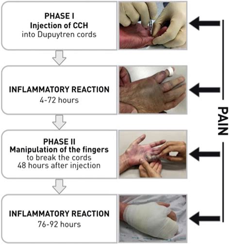 Dupuytren’s contracture treatment - Philadelphia Holistic Clinic