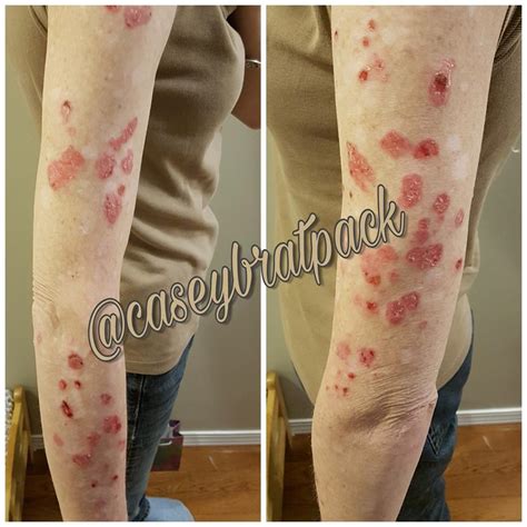 26 Photos That Show How Autoimmune Disease Affects the Skin | The Mighty