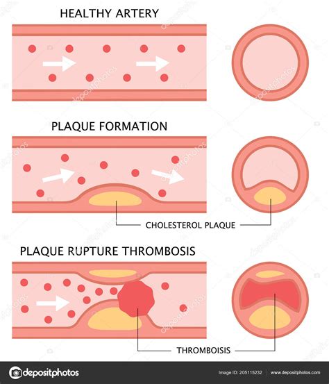 Atherosclerosis Stages Healthy Artery Plaque Formation Thrombosis Flat ...