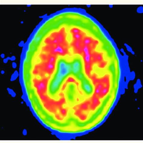 Amyloid PET scan in Alzheimer's disease. Colour image of an amyloid PET ...