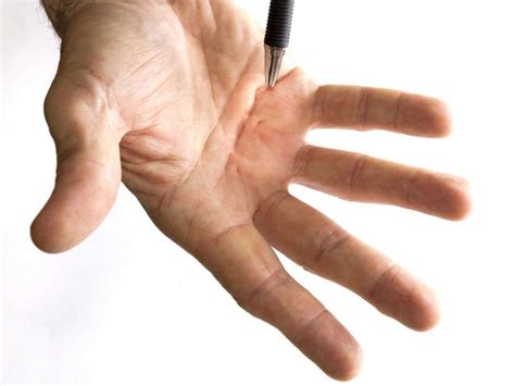 Dupuytren's Contracture - Symptom, Causes & Ultimate Top 6 Risk Factor