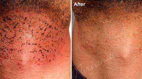 Side Effects Of Laser Hair Removal - Effect Choices