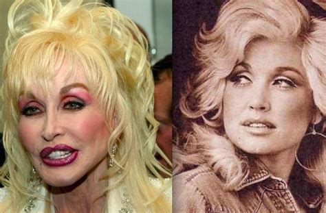 Dolly Parton’s Plastic Surgery, The Many Procedures She Had Done ...