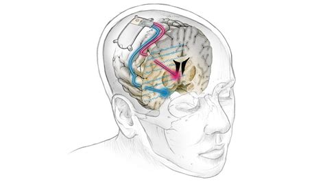 NeuroPace RNS – NIH Director's Blog