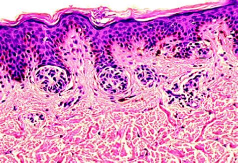 Pathology of Melanocytic Skin Tumors | Oncohema Key