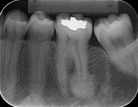 Periapical radiograph showing radiopaque halo around the root of tooth ...