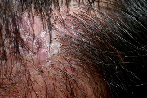 Mild Folliculitis Scalp Treatment