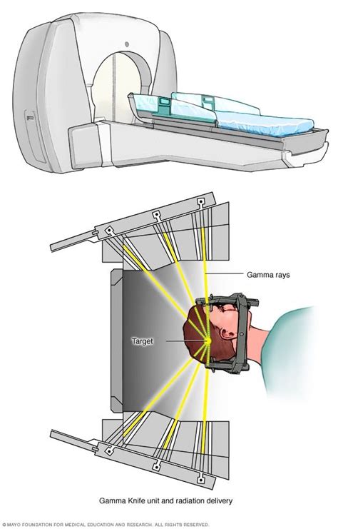 Gamma Knife stereotactic radiosurgery | Brain tumor, Neuroma, Tumor