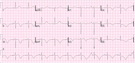 Dr. Smith's ECG Blog: Long QT Syndrome with Continuously Recurrent ...