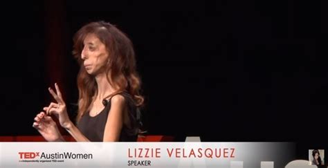 Lizzie Velasquez Talks About How Being Called The ‘World’s Ugliest ...