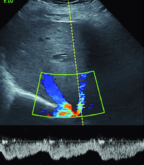 Color Doppler ultrasonogram of the liver showing patency of the hepatic ...