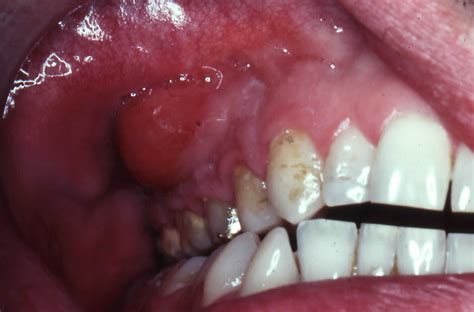 Abscess tooth, dental abscess causes, signs, symptoms, diagnosis ...